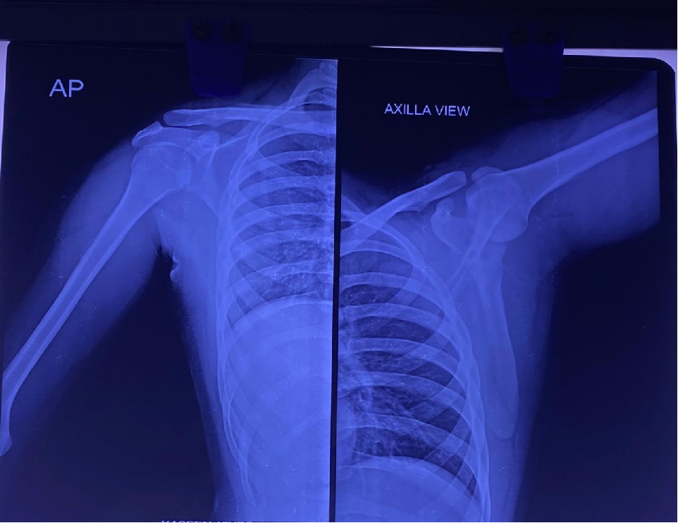 16-year-Male presented with Swelling in right upper limb since 5 months, increasing in size since then, Episodes of high grade of fever and weakness in right upper limb