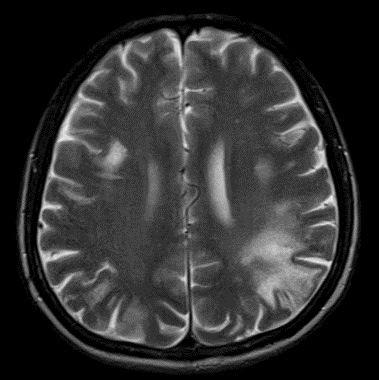 63 years old known case of polycythemia on treatment. Recently developed secondary myelofibrosis. 