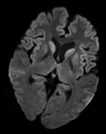 A 45 years, old female patient presented with complaints of insomnia, impaired memory, behavior changes, confusion, progressive psychosis and urinary incontinence. 