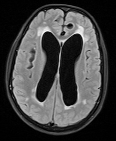 51  yr old male presented with abnormal behaviour.