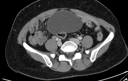 46 Year old female patient presents with right iliac fossa and supraumbilical pain, loose stools