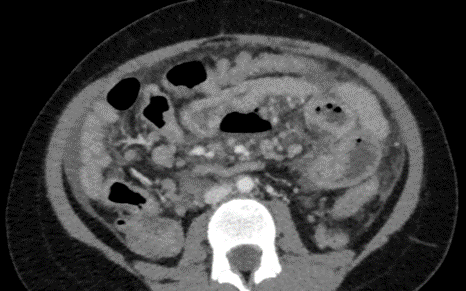 7 year old, female child presented with intermittent abdominal pain (lasting for 15-20 min), vomiting (4-5 episodes non bilious) and fever for 2 days. Not passed stools since 2 days.