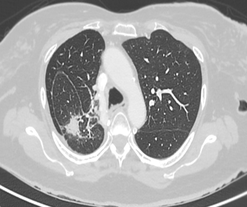 A 71-year-old lady presented with left flank pain. She was a follow up case of adenocarcinoma lung– status post lobectomy, chemoradiation and currently on maintenance chemotherapy.