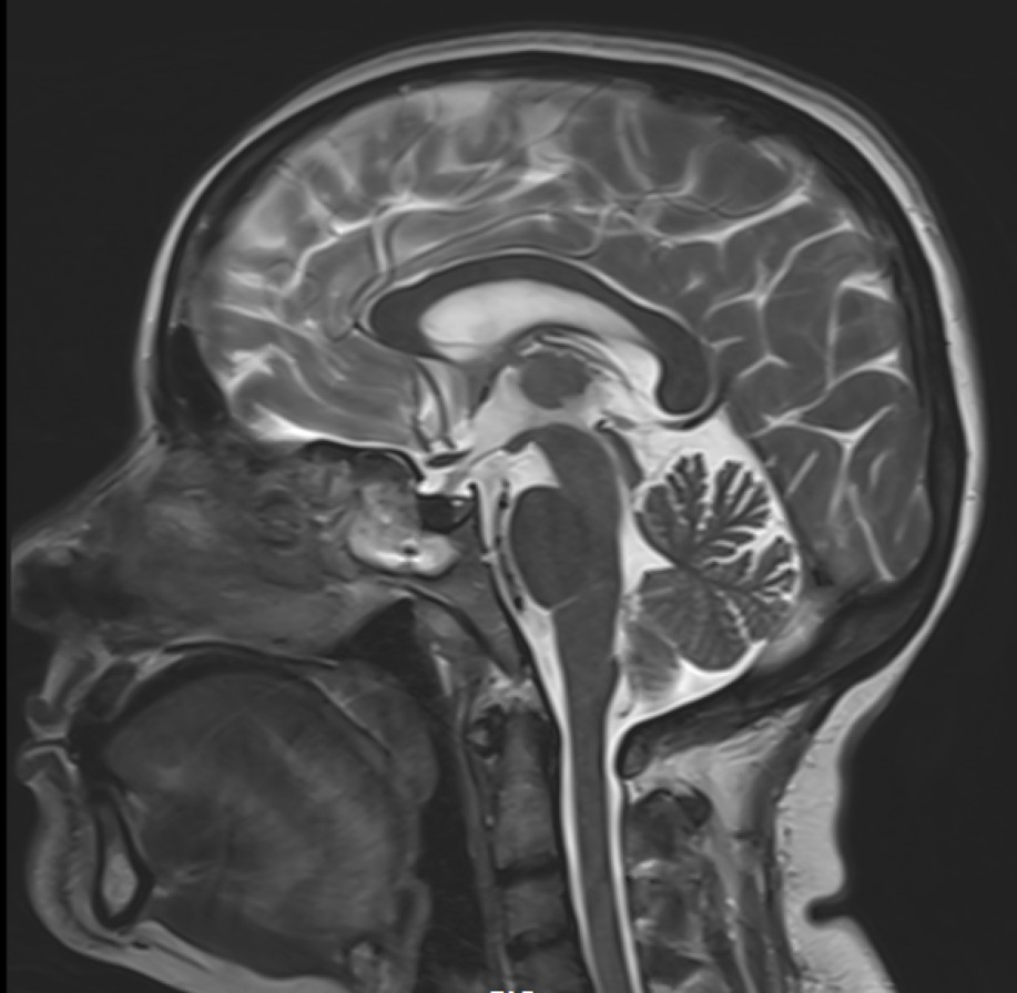 A 43-year-old lady who was a known case of chronic kidney disease was being evaluated for headache and orbito - nasal symptoms