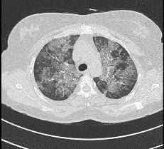 Walk in OPD patient with History of on and off mild breathlessness and fever since 6 months.