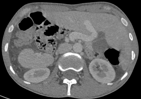 A 27 year old gentleman presented with few episodes of hemoptysis. He also had a history of cough with expectoration since few months.
