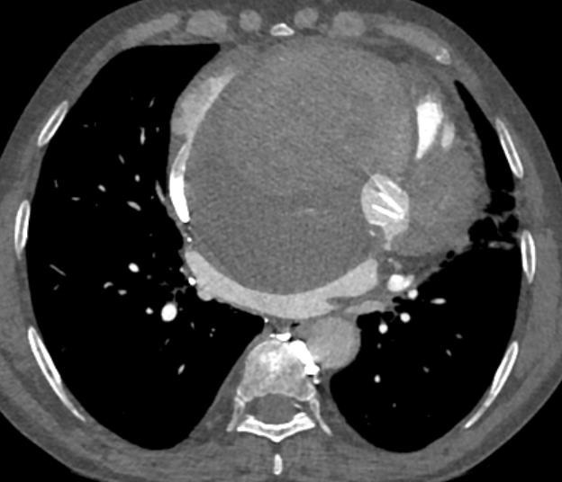 A 54 years old, male patient presented with complaints of swelling in the bilateral lower limbs and breathlessness.