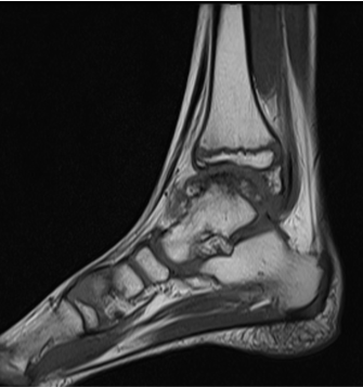 7 year old male child presented with complaints of walking on toes and swelling over left lower limb joints. No history of trauma.