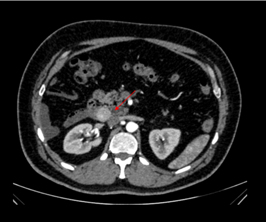 48 year old male  Presented with history of 3 episodes of melena.  No known comorbidities  Gastro -Duodenoscopy - Erosive duodenitis Colonoscopy – unremarkable. 