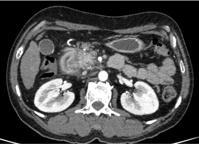 49 year male, presents with abdominal pain since 3 days.  No h/o loose stools, vomiting.