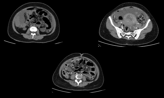 24 year young lady presented with complains of severe abdominal pain predominantly in the lower abdomen.  Known case of uterine fibroids. Recently diagnosed with diabetes. 