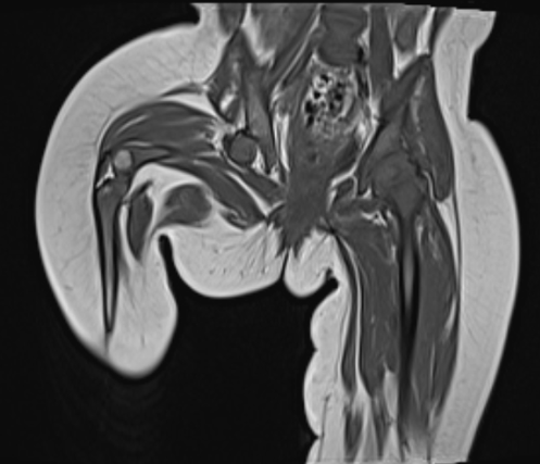An 18 month old baby presented with hip deformity – MRI bilateral hips was advised