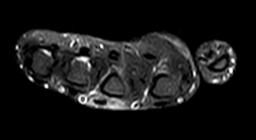 A 52-year-old male presented with history of injury to the right hand 1 month ago following which there was pain predominantly along the right middle finger.