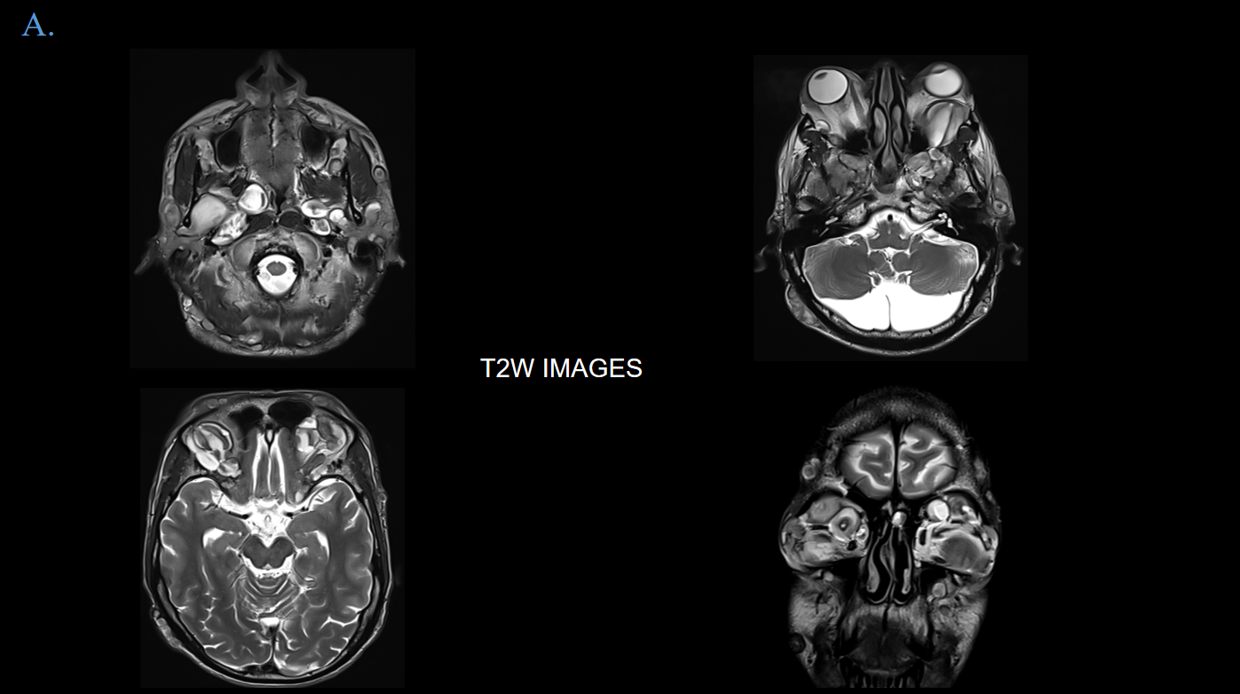 A 33 year old male,  History of proptosis in both eyes since 2 years.  Headache and vertigo since 2 years.  History of intermittent fever. No history of seizures. 