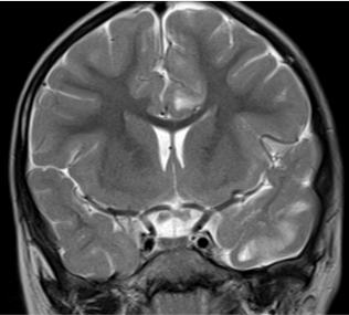 3 year 11 month old female child presenting with complaints of three episodes of seizures lasting for 1-5  minutes with no regain of consciousness in between. 