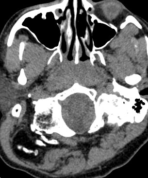 A 33 year old male with swelling on the back of the neck. On external examination no erythema over the swelling, non-tender.  