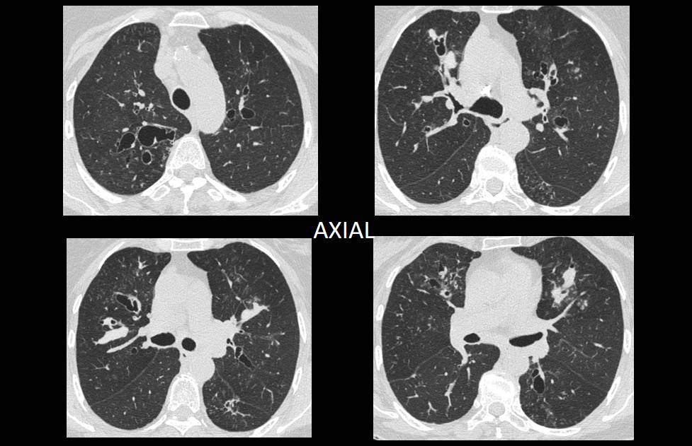 67 years old female presenting with complaints of Chronic cough, One episode of hemoptysis