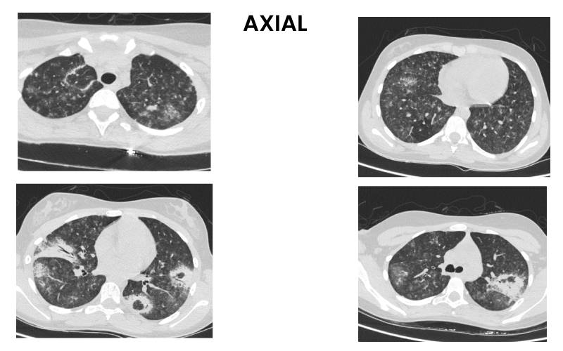 12 years old female presenting with complaints of FEVER, JOINT PAIN, VOMITING, HEMATURIA