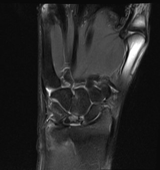 22 year male, History of fall long back, now presents with right wrist joint pain
